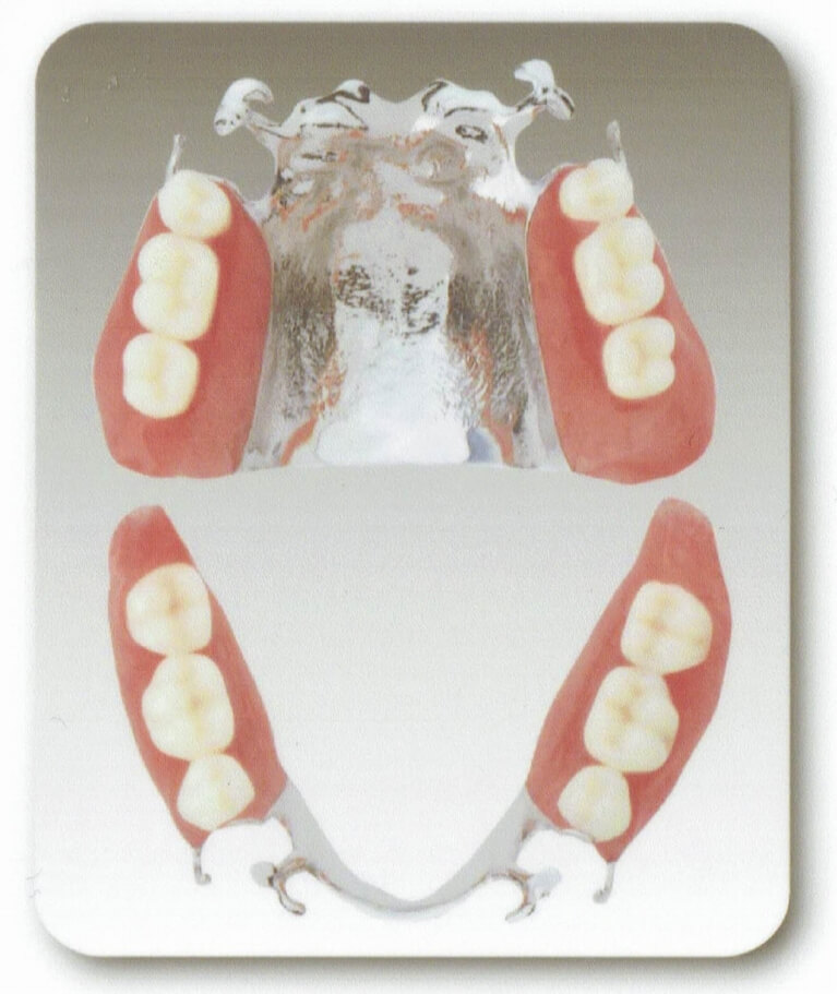 薄くて丈夫なコバルトクロムの入れ歯