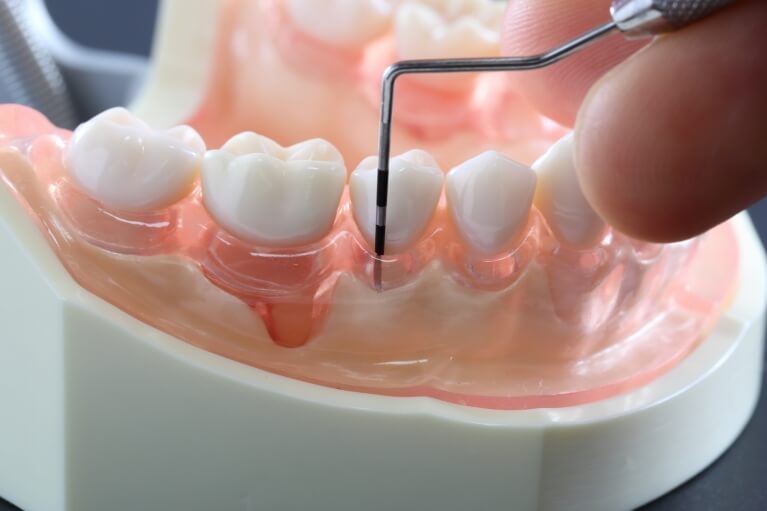まずは検査でどのぐらい歯周病が進行しているのかをチェック