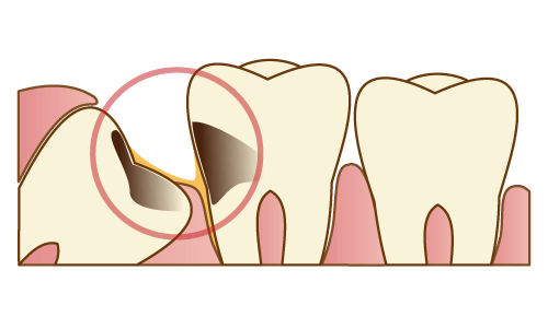 親知らずが虫歯になっている・親知らずの隣が虫歯になっている