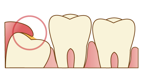 親知らずのまわりの歯茎が腫れている