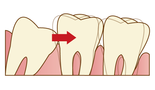 歯並びの乱れの原因になっている